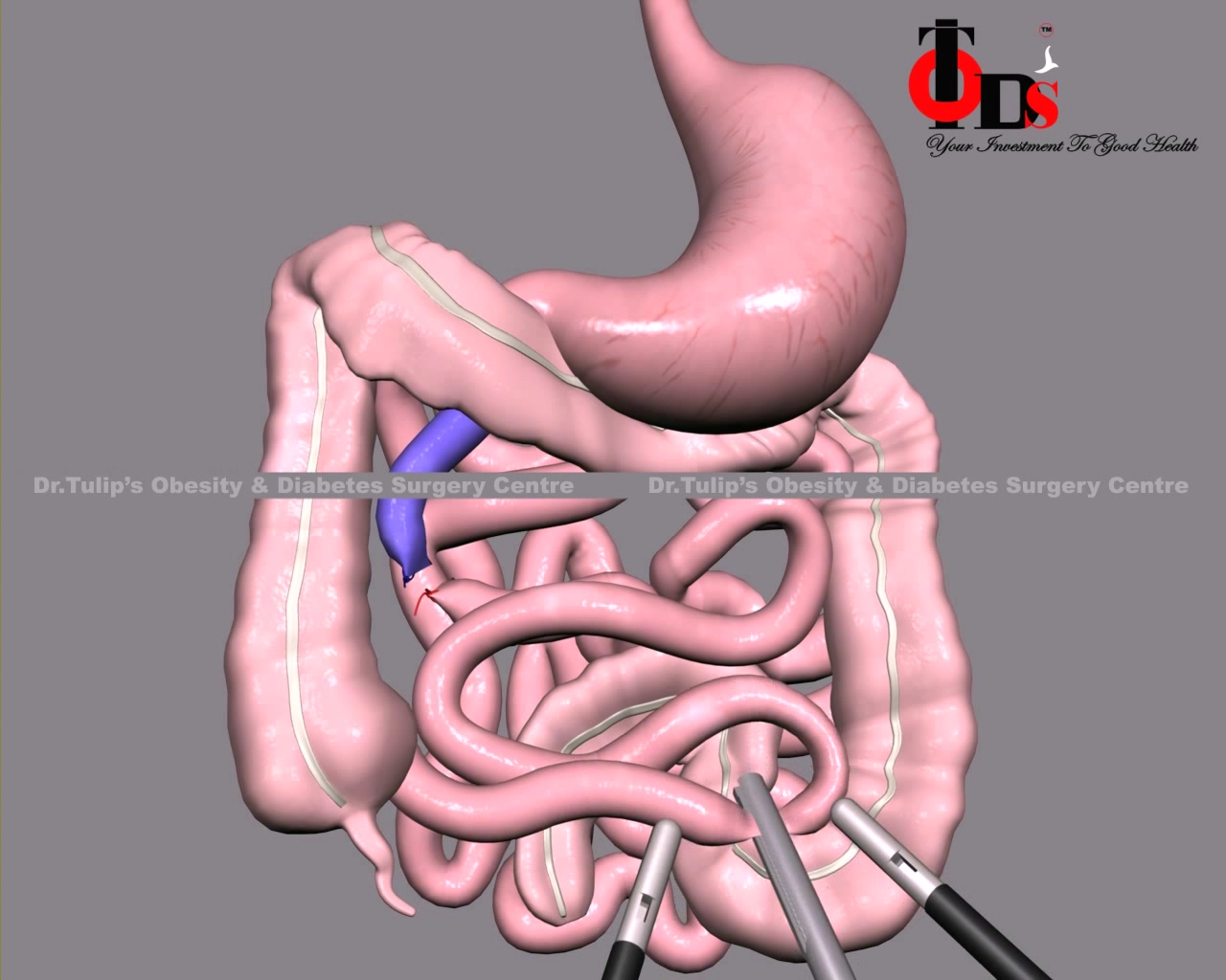 Ileal Interposition Surgery